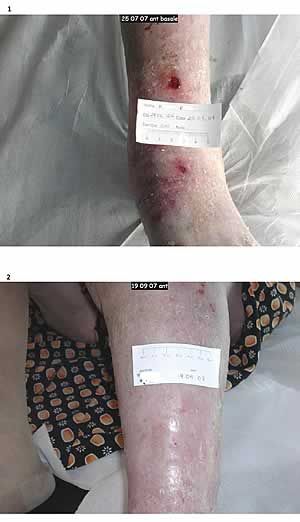 Caso clinico – lesioni sulla superficie anteriore della gamba